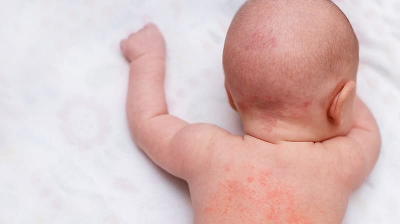 אסטמת עור - דלקת עור אטופית