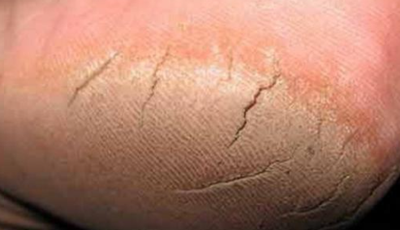 وصفات طبيعية لإزالة تشققات القدمين