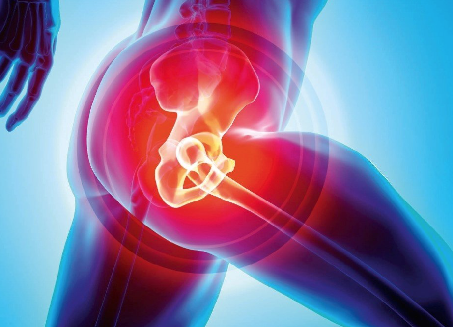 Hip Replacement