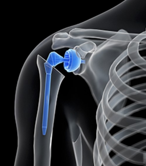 Shoulder Replacement