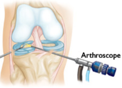 Knee Arthroscopy