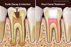 Root canal treatment