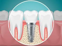 DENTAL IMPLANTS