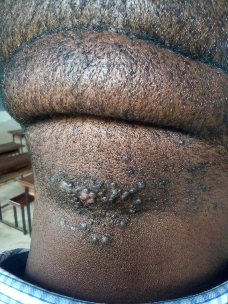 ACNE KELOID HERBS