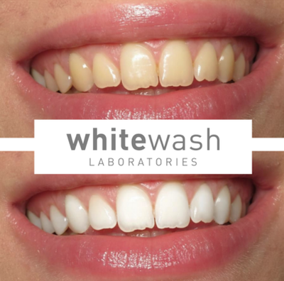 Tooth Whitening image