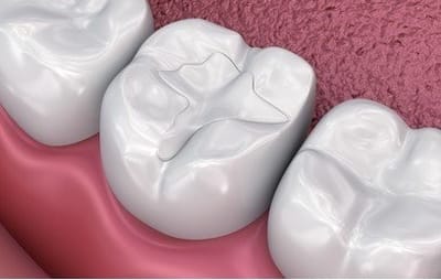 white fillings image