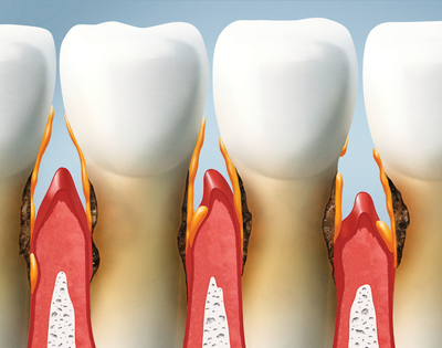 Gum treatment image