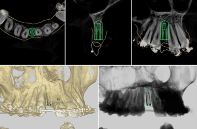 Implantes com planejamento digital e cirurgia guiada image