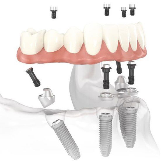 Implantes Dentarios