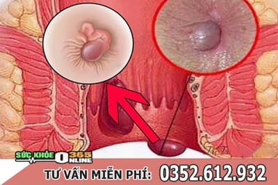 Cach lam co bui tri ngoai hieu qua