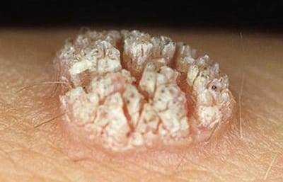 Con duong lay truyen sui mao ga