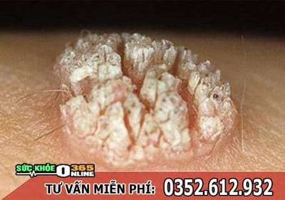 Sui mao ga co gay ngua khong