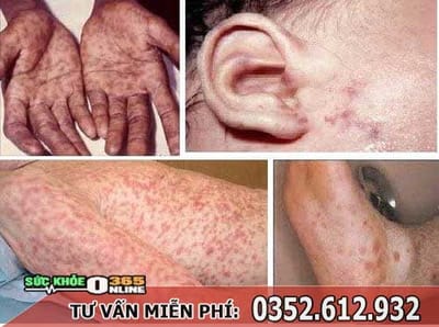 Mac benh giang mai co con khong