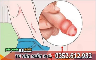 Viem bao quy dau co lay khong