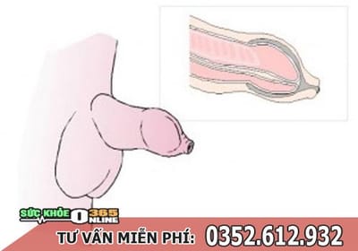 Cac benh bao quy dau thuong gap