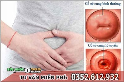 Dot viem lo tuyen bao nhieu tien