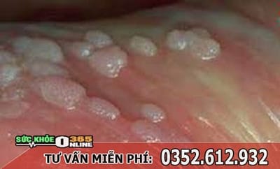 Noi mun trang o bao quy dau