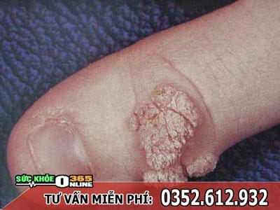 Nguy hiem benh sui mao ga