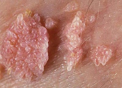 Sui mao ga lay duong nao