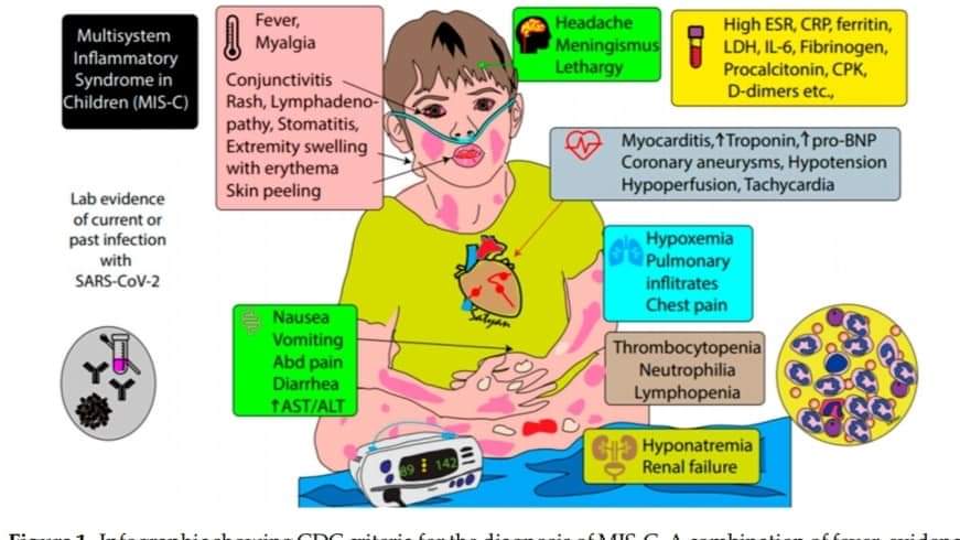 تشخيص وعلاج متلازمة التهاب الأجهزة المتعدد والمشابهه لمتلازمة كاواساكي عند الأطفال. للدكتور عروة محمد هاني الملي/المانيا