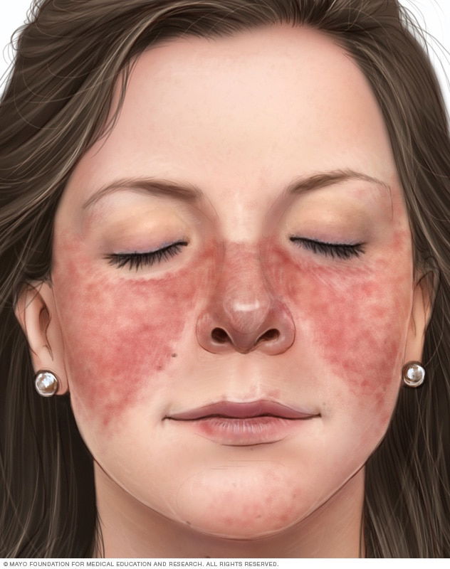 سلسلة الامراض المناعية وعلاجها حسب البروتوكولات الألمانية
الذئبة الحمامية. Lupus Erythematosus
الجزء الاول