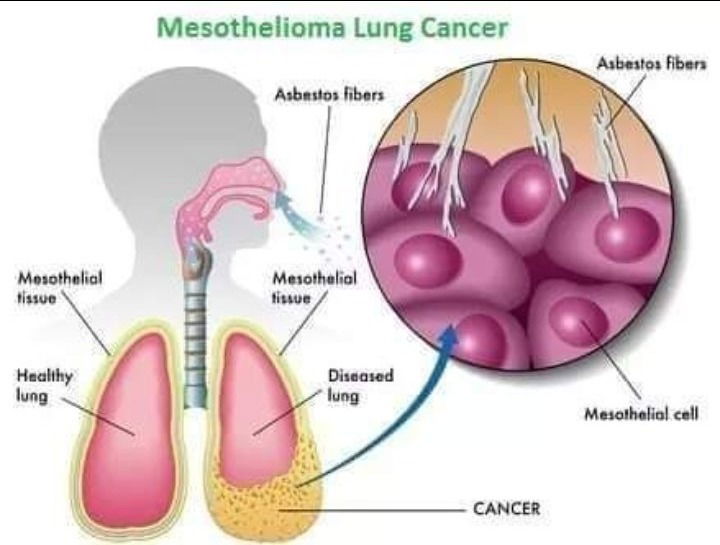 وَرَم المُتَوَسِّطَة Mesothelioma..