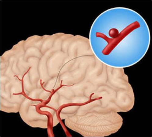 أم الدم Aneurysm