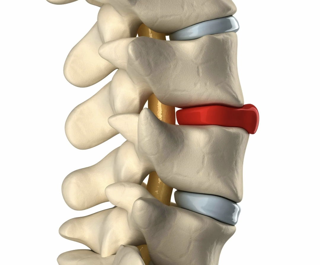الديسك (فتق النواة اللبية) حقيقة الابر الصينية والكي في العلاج