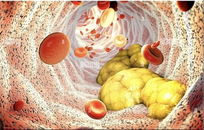 البروتين الدهني (أ)  والازمات القلبية لدى الشباب. Lipoprotein A and heart attack at a young age