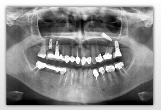 Implant Complications: Diagnosis, Prevention, and Treatment