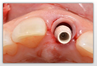 The Role of the Restorative Dentist in the Management of Immediate Implant Placement in Extraction Sites