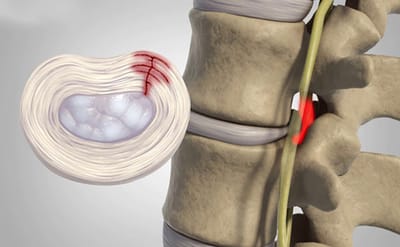 Thoat vi dia dem that lung la gi?