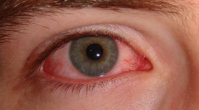 Conjunctivitis image