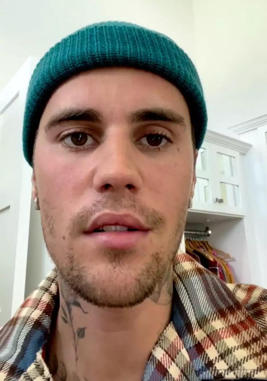 JUSTIN BIEBER 患上「拉姆齊亨特綜合症」導致半邊臉癱瘓，巡迴演唱會將延遲舉行