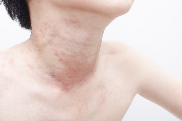 Urticaria