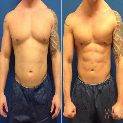 The Advantages of Vaser Lipo