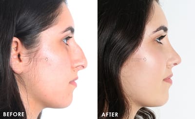 Nose Tip Plasty surgery that makes you look beautiful