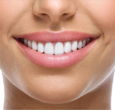 Veneers  image