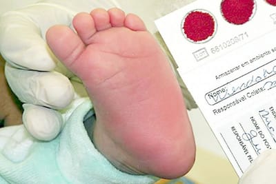 Diagnóstico precoce das doenças raras é discutido em audiência pública