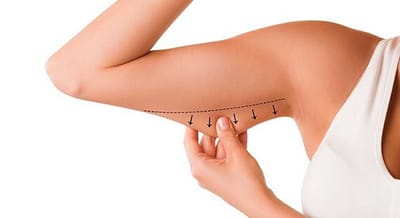 Getting the Best Arm Lift After Significant Weight Loss