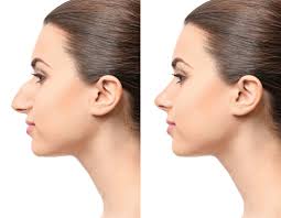 Revision Rhinoplasty