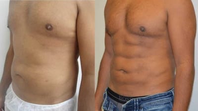 Vaser Liposuction Treatment: A Safer Option