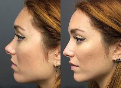 Primary Rhinoplasty Surgery