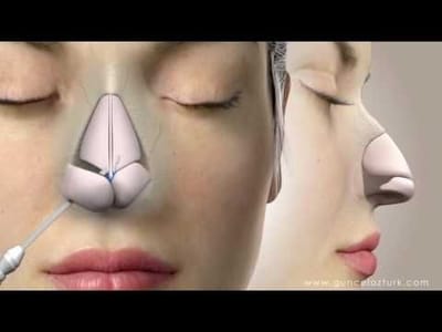 Brief Guide to Rhinoplasty in Dubai | UAE