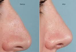 العوامل التي يجب مراعاتها فيما يتعلق بعملية تجميل الأنف في دبي | الإمارات العربية المتحدة