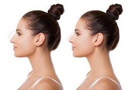 قبل إجراء عملية تجميل الأنف - سبع نصائح مهمة للتحضير في دبي وأبو ظبي