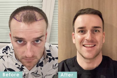 Why Hair Transplants Are Gaining Popularity