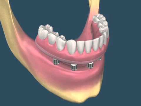 Prótese Protocolo sobre Implantes: Restaurando a Função e Estética de Seu Sorriso