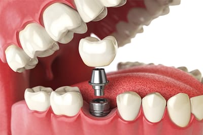 Implantes Dentários: Restaurando Seu Sorriso com Segurança e Durabilidade