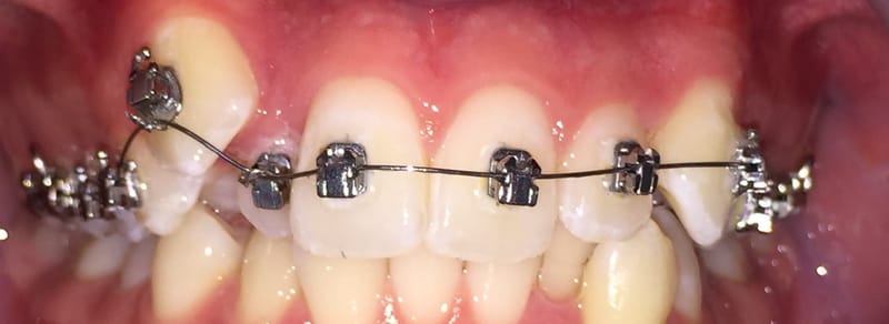 Frenos Chicos (muy estético)